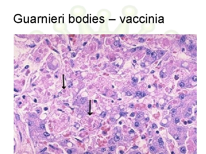 Guarnieri bodies – vaccinia 