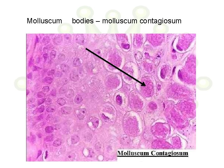 Molluscum bodies – molluscum contagiosum 