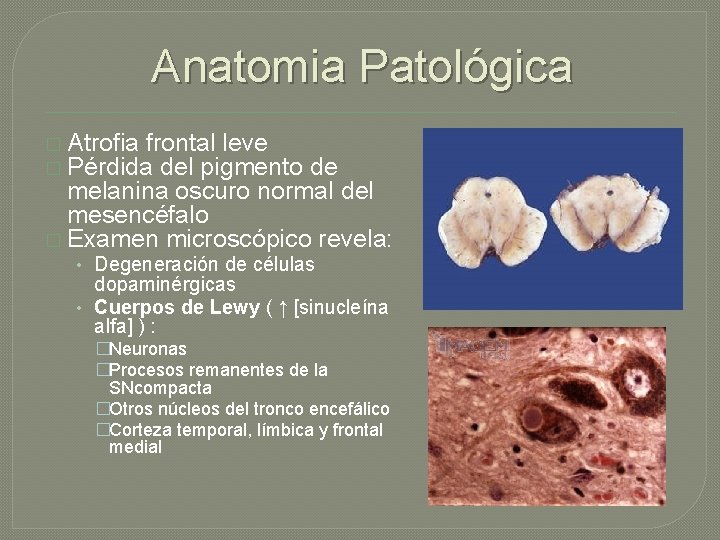 Anatomia Patológica � Atrofia frontal leve � Pérdida del pigmento de melanina oscuro normal