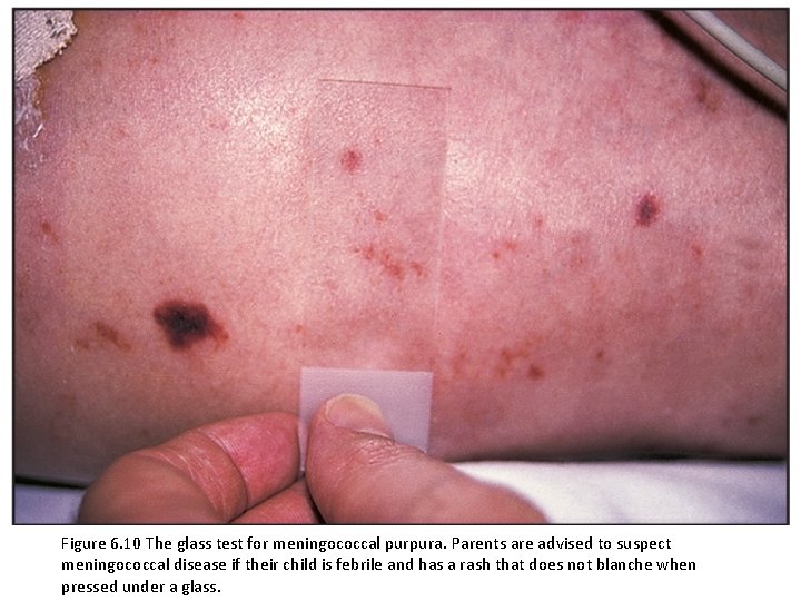 Figure 6. 10 The glass test for meningococcal purpura. Parents are advised to suspect