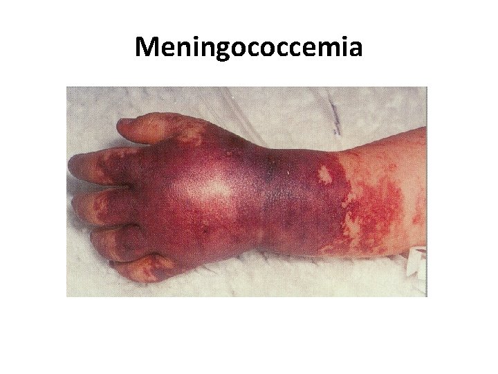 Meningococcemia 