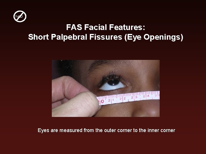 FASD FAS Facial Features: Short Palpebral Fissures (Eye Openings) Eyes are measured from the