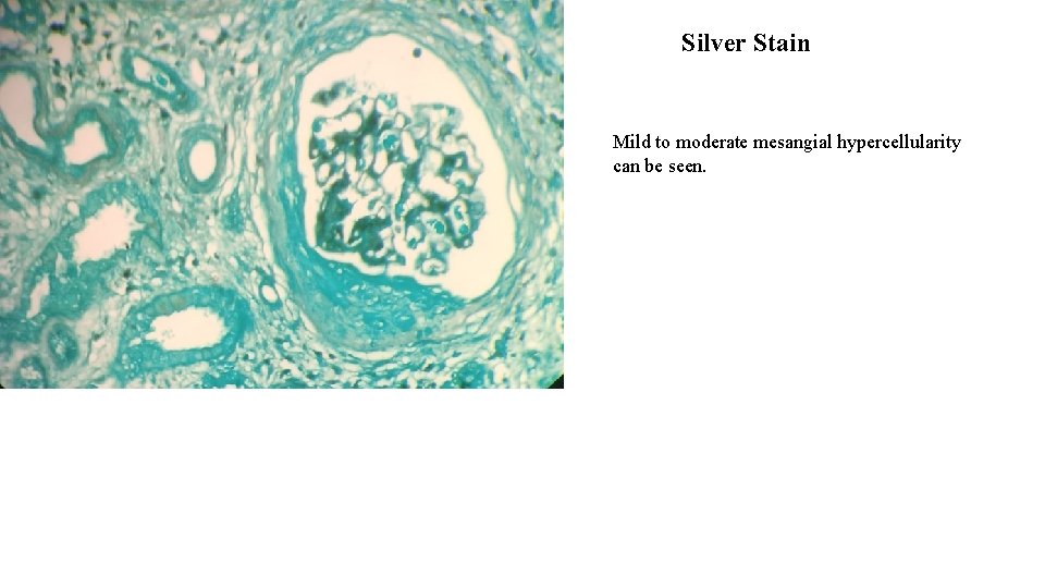 Silver Stain Mild to moderate mesangial hypercellularity can be seen. 