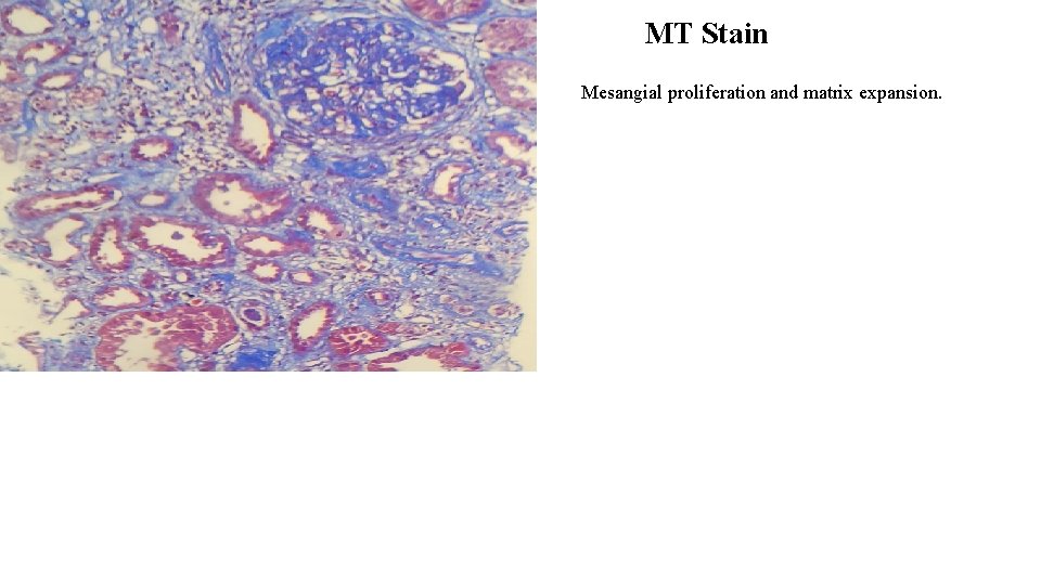 MT Stain Mesangial proliferation and matrix expansion. 