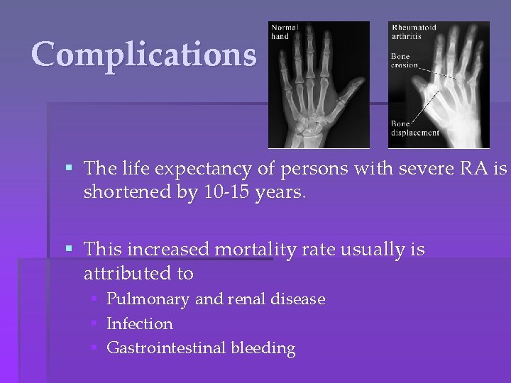 Complications § The life expectancy of persons with severe RA is shortened by 10