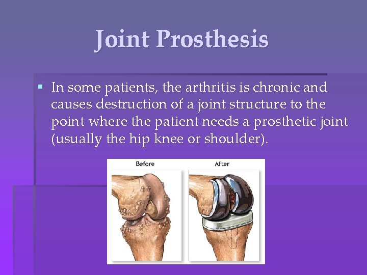 Joint Prosthesis § In some patients, the arthritis is chronic and causes destruction of