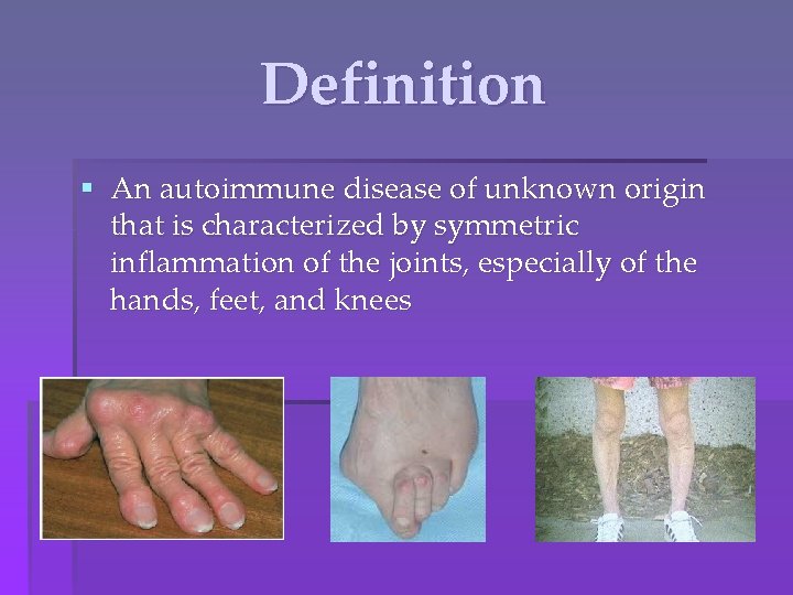 Definition § An autoimmune disease of unknown origin that is characterized by symmetric inflammation