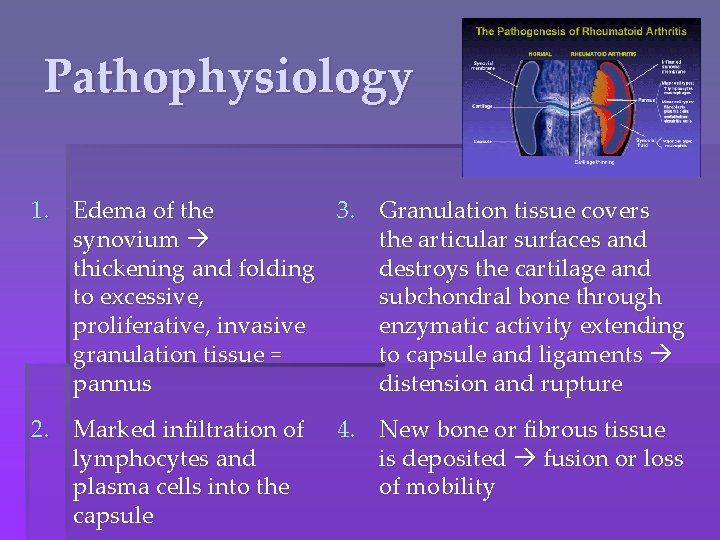 Pathophysiology 1. Edema of the 3. Granulation tissue covers synovium the articular surfaces and