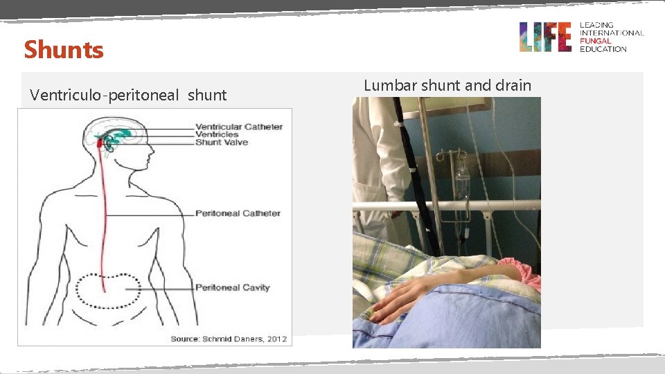 Shunts Ventriculo-peritoneal shunt Lumbar shunt and drain 