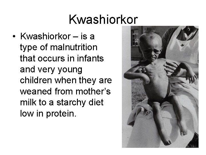 Kwashiorkor • Kwashiorkor – is a type of malnutrition that occurs in infants and