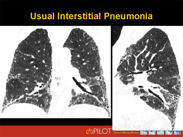 Usual Interstitial Pneumonia 
