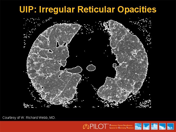 UIP: Irregular Reticular Opacities Courtesy of W. Richard Webb, MD. 