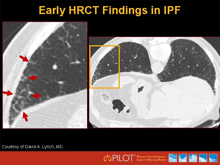 Early HRCT Findings in IPF Courtesy of David A. Lynch, MD. 