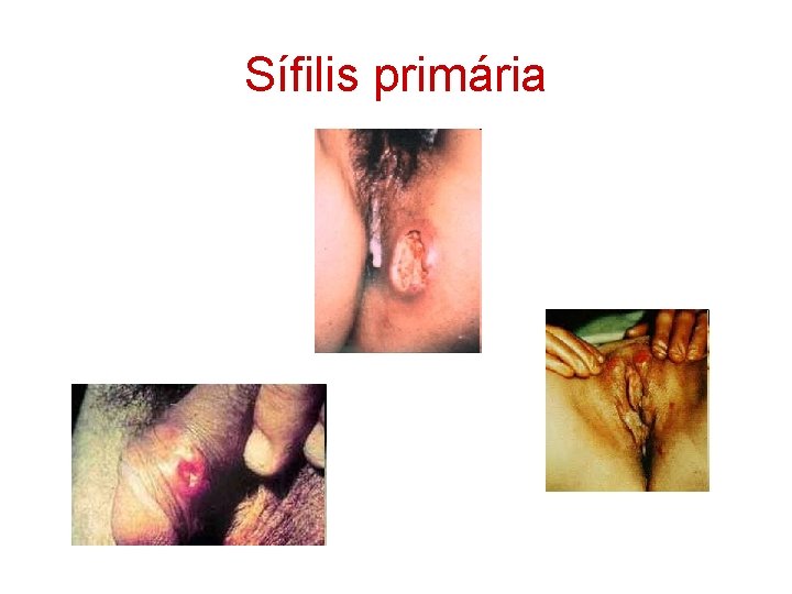 Sífilis primária 