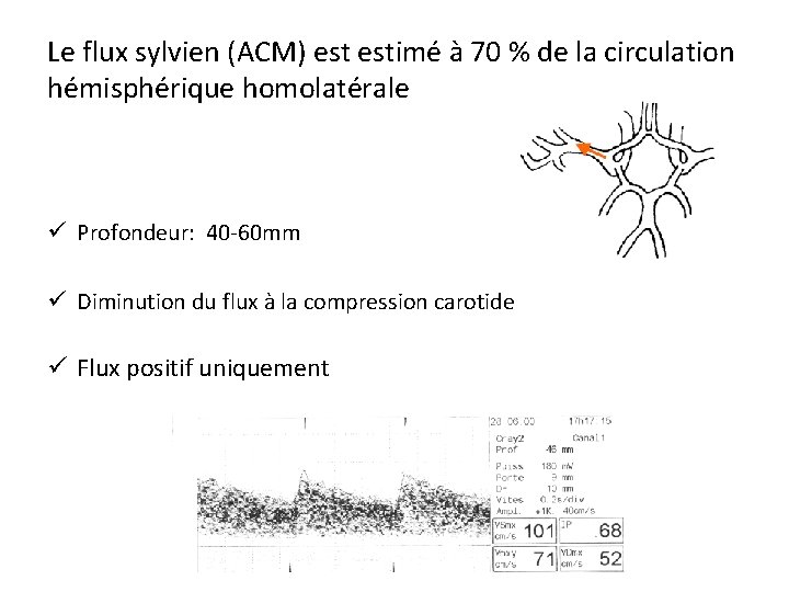 Le flux sylvien (ACM) estimé à 70 % de la circulation hémisphérique homolatérale ü