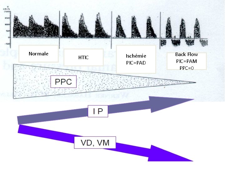 Normale HTIC Ischémie PIC=PAD Back Flow PIC=PAM PPC=0 