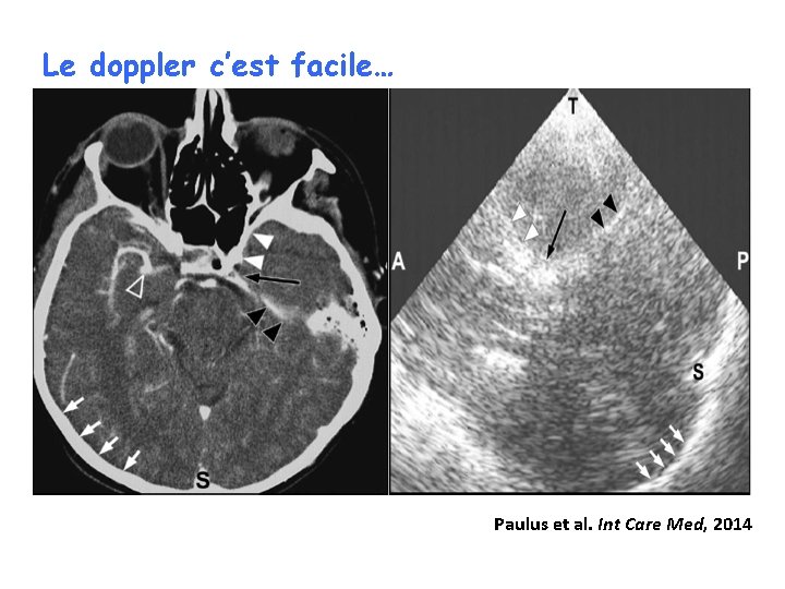Le doppler c’est facile… Paulus et al. Int Care Med, 2014 
