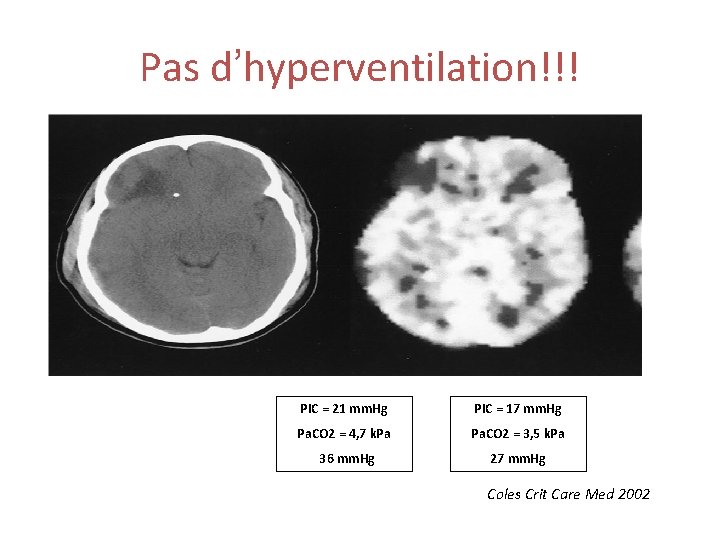 Pas d’hyperventilation!!! PIC = 21 mm. Hg PIC = 17 mm. Hg Pa. CO