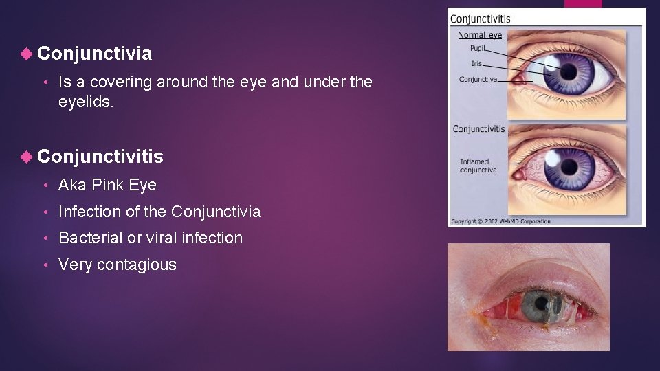 Conjunctivia • Is a covering around the eye and under the eyelids. Conjunctivitis Conjunctivia • Is a covering around the eye and under the eyelids. Conjunctivitis