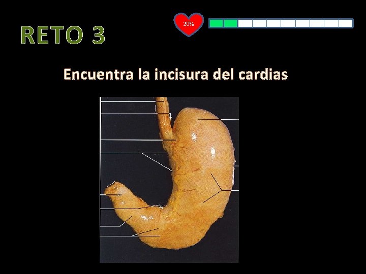 RETO 3 20% Encuentra la incisura del cardias 