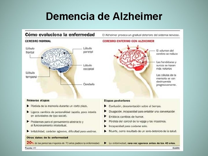 Demencia de Alzheimer 