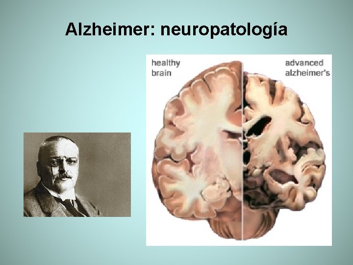 Alzheimer: neuropatología 