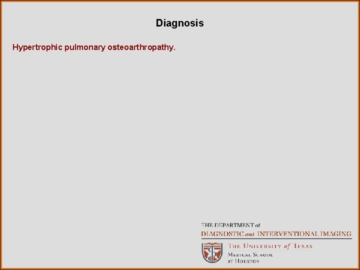 Diagnosis Hypertrophic pulmonary osteoarthropathy. 
