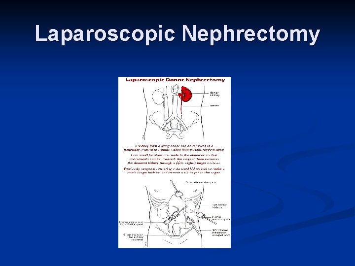 Laparoscopic Nephrectomy 