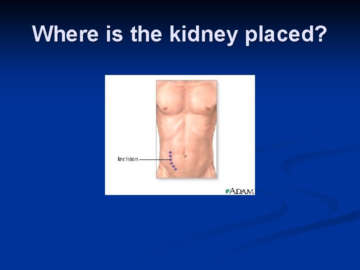 Where is the kidney placed? 