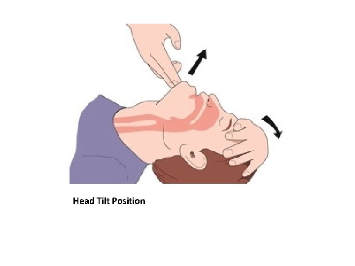 Head Tilt Position 