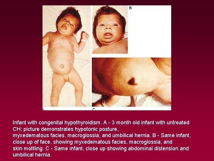 Infant with congenital hypothyroidism. A - 3 month old infant with untreated CH; picture