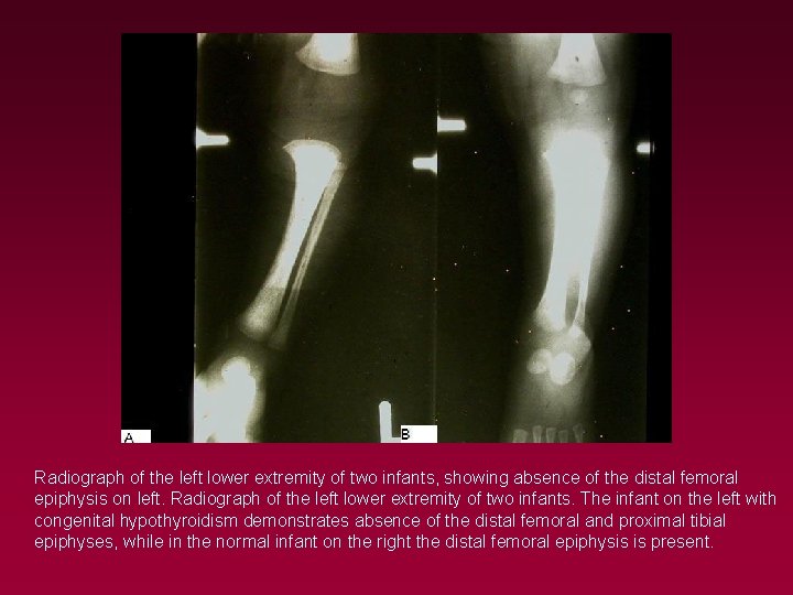 Radiograph of the left lower extremity of two infants, showing absence of the distal