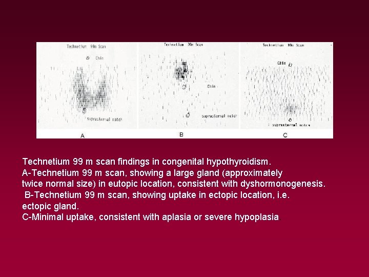 Technetium 99 m scan findings in congenital hypothyroidism. A-Technetium 99 m scan, showing a