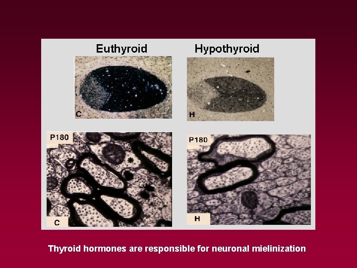 Thyroid hormones are responsible for neuronal mielinization 
