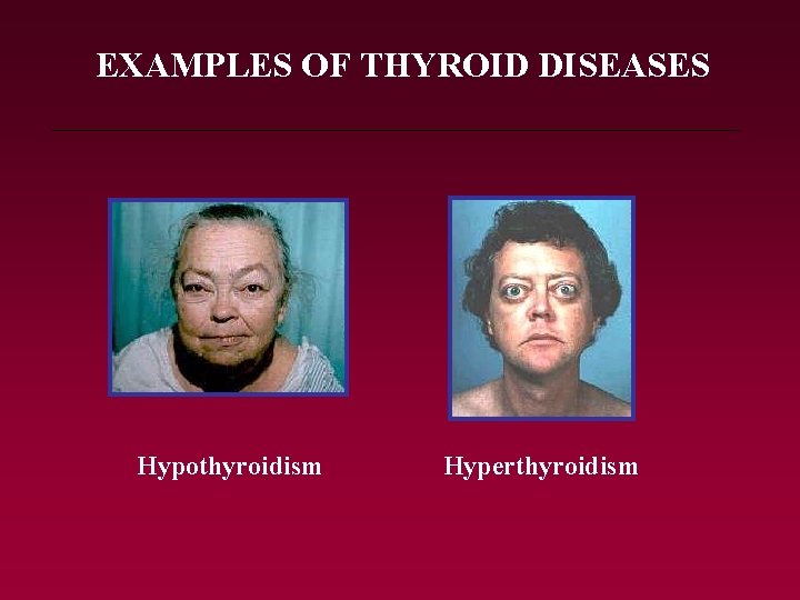 EXAMPLES OF THYROID DISEASES Hypothyroidism Hyperthyroidism 