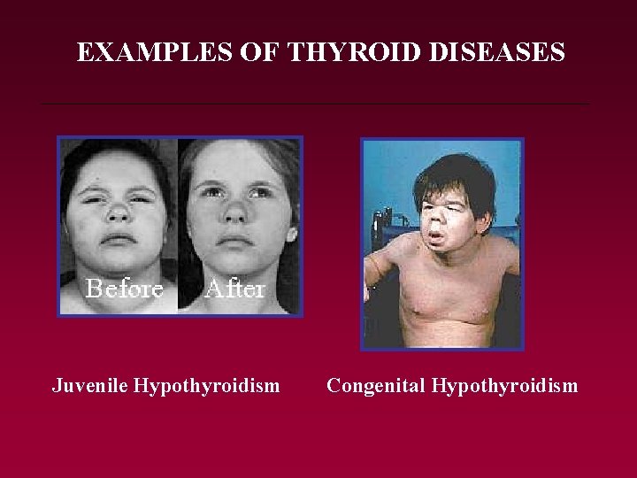 EXAMPLES OF THYROID DISEASES Juvenile Hypothyroidism Congenital Hypothyroidism 