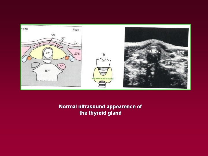 Normal ultrasound appearence of the thyroid gland 