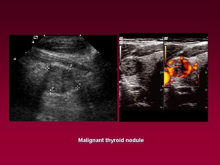 Malignant thyroid nodule 