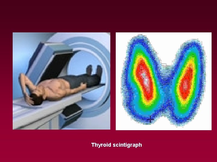 Thyroid scintigraph 