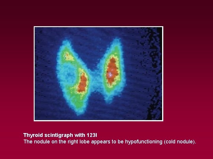 Thyroid scintigraph with 123 I The nodule on the right lobe appears to be