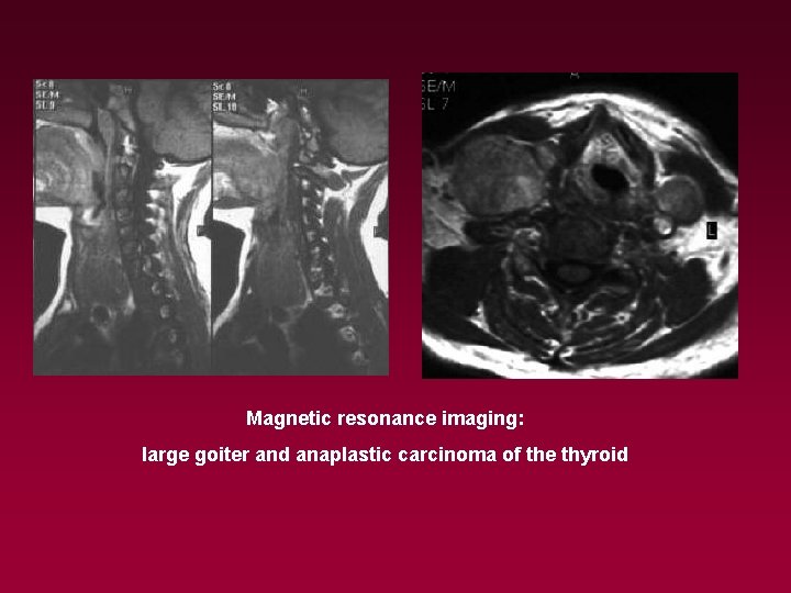 Magnetic resonance imaging: large goiter and anaplastic carcinoma of the thyroid 