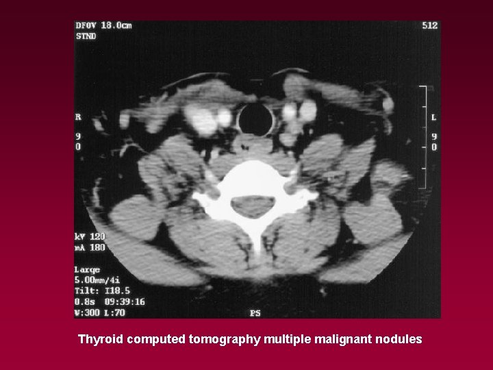 Thyroid computed tomography multiple malignant nodules 