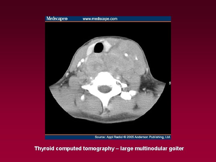 Thyroid computed tomography – large multinodular goiter 