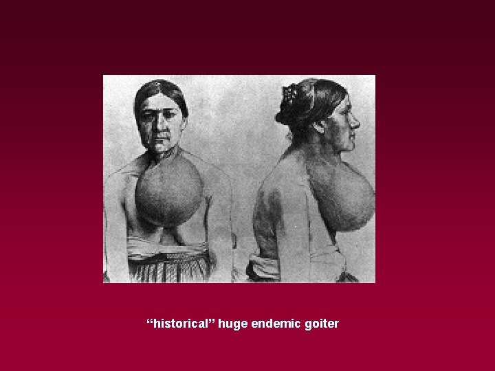 “historical” huge endemic goiter 