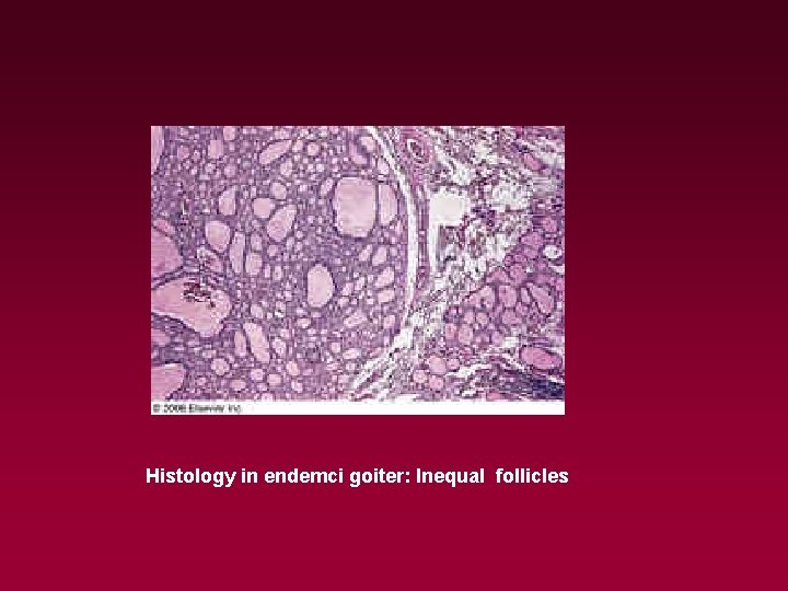 Histology in endemci goiter: Inequal follicles 