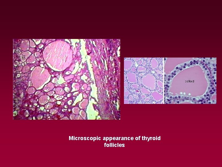 Microscopic appearance of thyroid follicles 