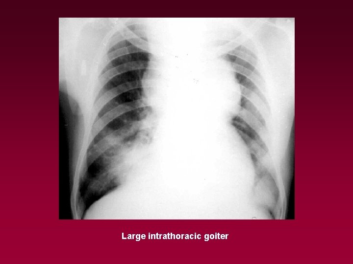 Large intrathoracic goiter 