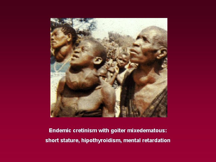 Endemic cretinism with goiter mixedematous: short stature, hipothyroidism, mental retardation 
