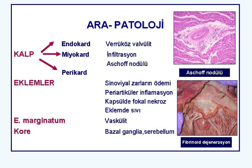 ARA- PATOLOJİ KALP Endokard Verrüköz valvülit Miyokard İnfiltrasyon Aschoff nodülü Perikard Aschoff nodülü EKLEMLER