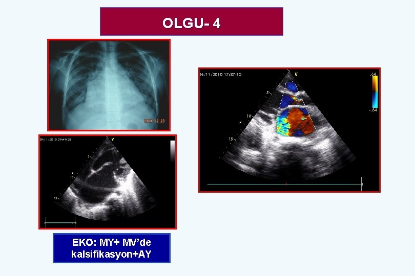 OLGU- 4 EKO: MY+ MV’de kalsifikasyon+AY 